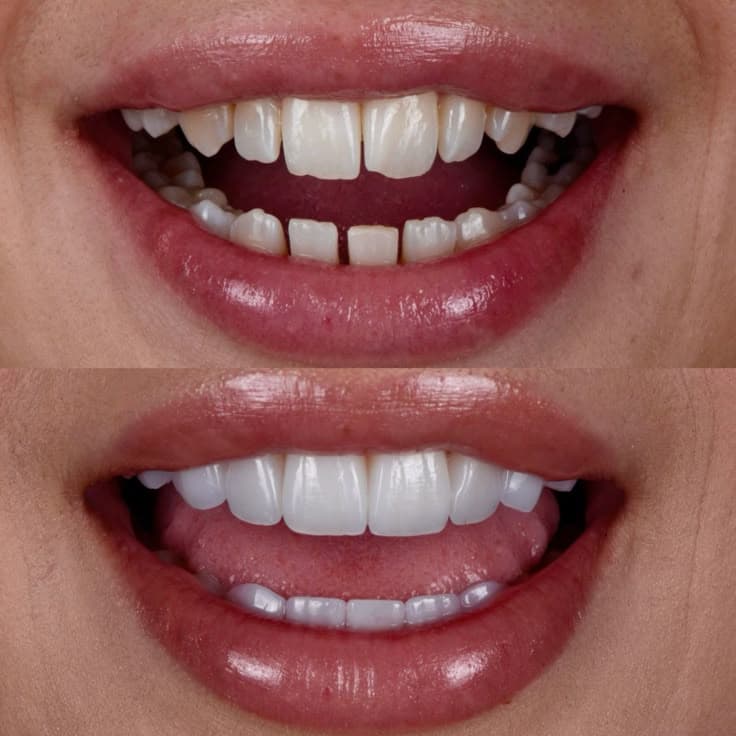 Cuidados após o implante dentário: o que fazer no pós-operatório